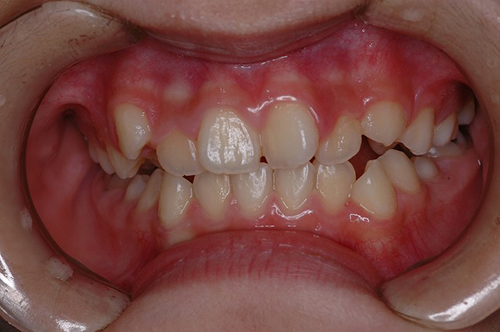 ケース⑤：非抜歯　叢生　１2歳女性その１ 治療前