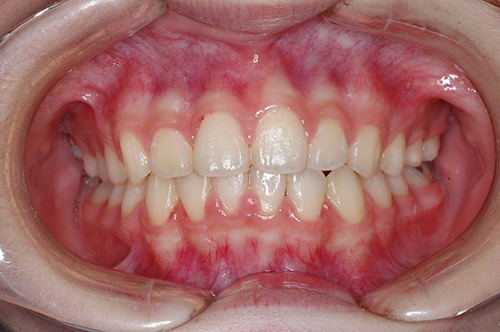 ケース⑤：非抜歯　叢生　１2歳女性その１ 治療後