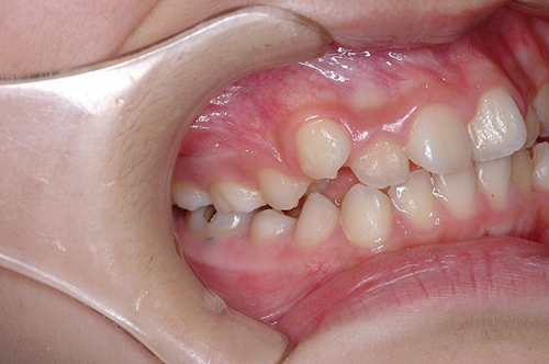 ケース⑤：非抜歯　叢生　１2歳女性その２ 治療前