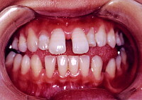 ケース①：開咬、空隙歯列　17歳女性　その１ 治療前
